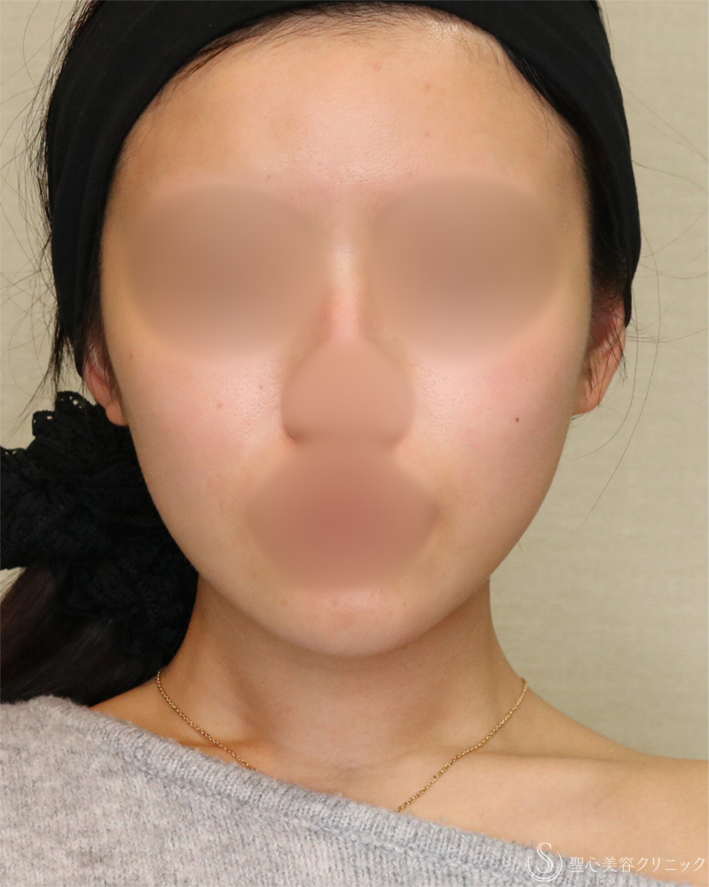 【20代女性・シャープで整った小顔】脂肪吸引（頬・顎下）（2年後） After 
