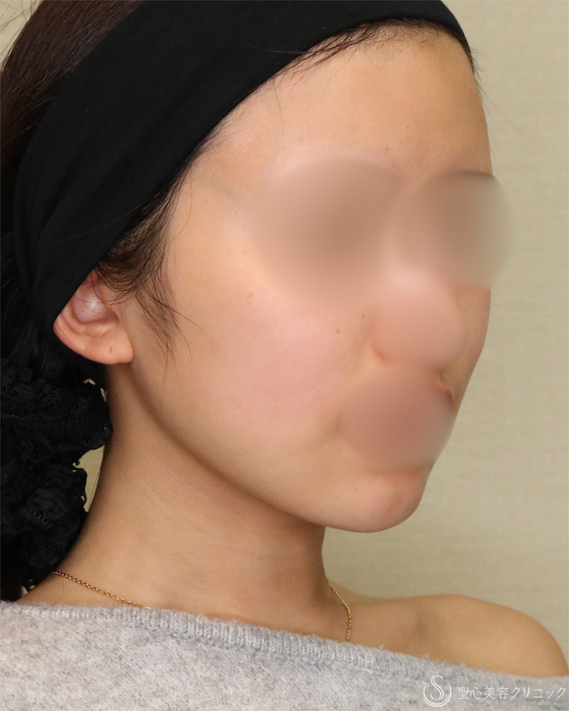 【20代女性・シャープで整った小顔】脂肪吸引（頬・顎下）（2年後） After 