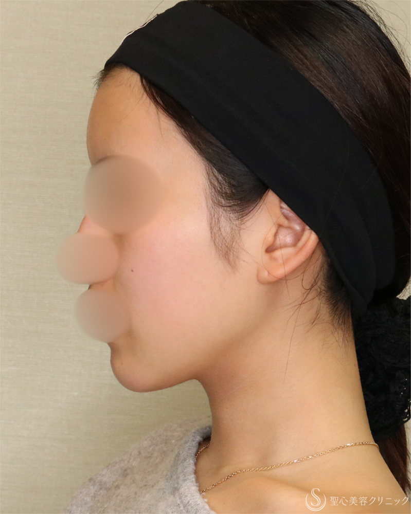 【20代女性・シャープで整った小顔】脂肪吸引（頬・顎下）（2年後） After 