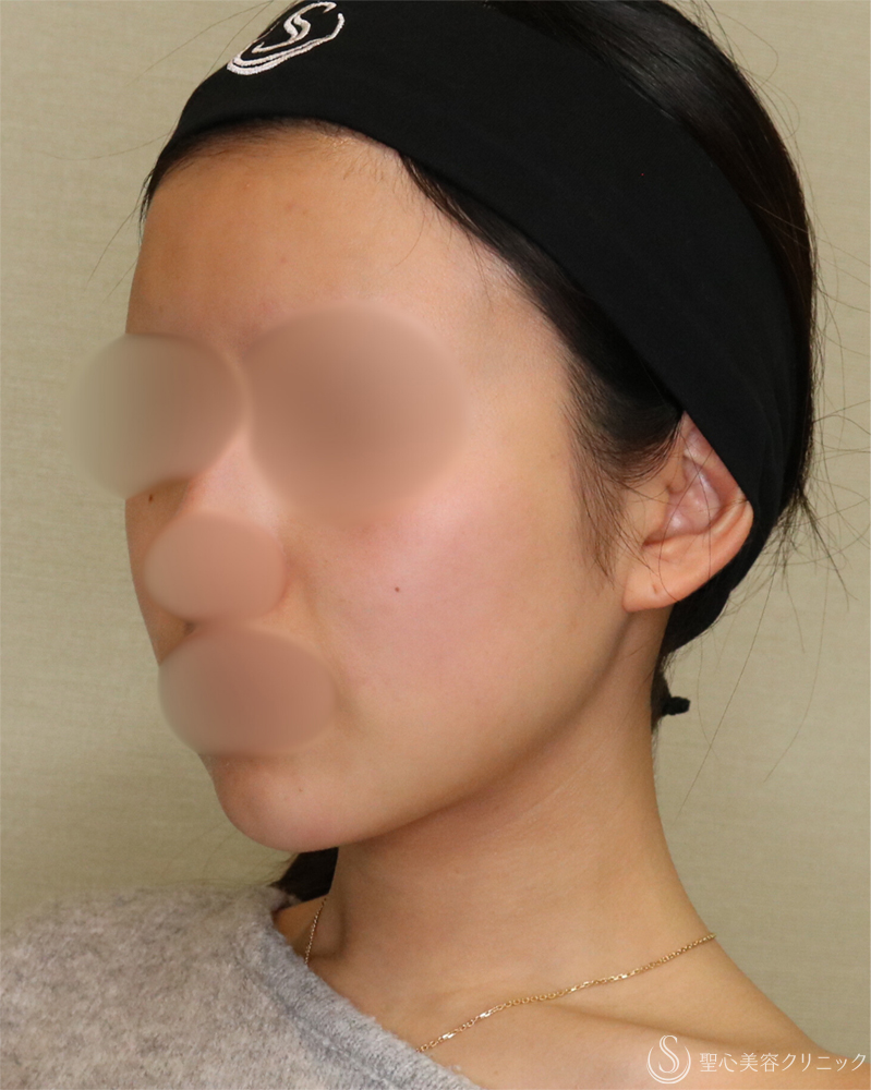 【20代女性・シャープで整った小顔】脂肪吸引（頬・顎下）（2年後） After 