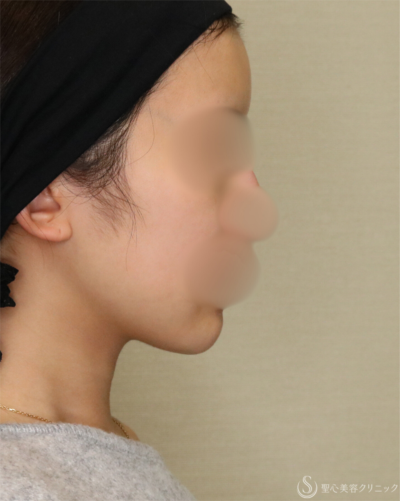 【20代女性・シャープで整った小顔】脂肪吸引（頬・顎下）（2年後） After 