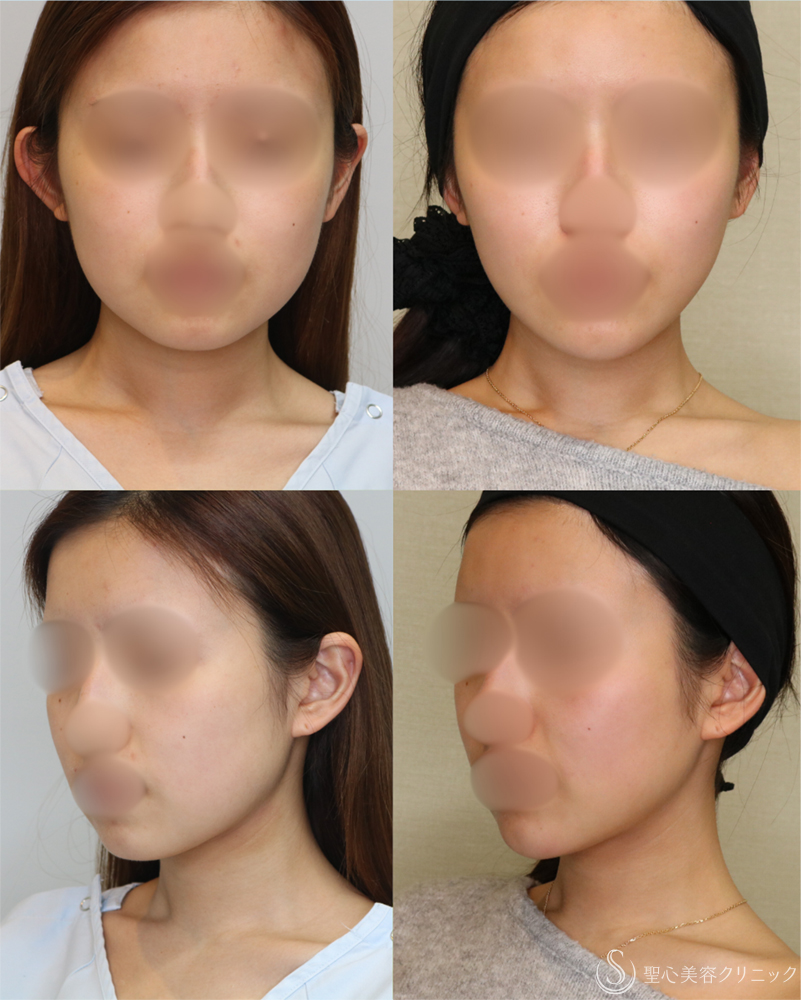 【20代女性・シャープで整った小顔】脂肪吸引（頬・顎下）（2年後） After 