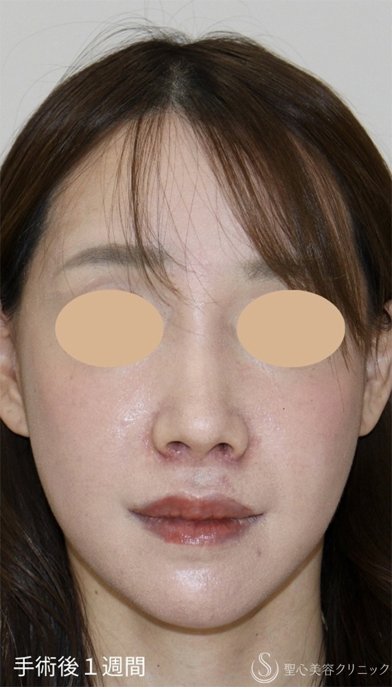 【30代女性・失われた構造を取り戻し、上品な“自然鼻”へ】鼻下短縮術（人中短縮）（1週間後） After 