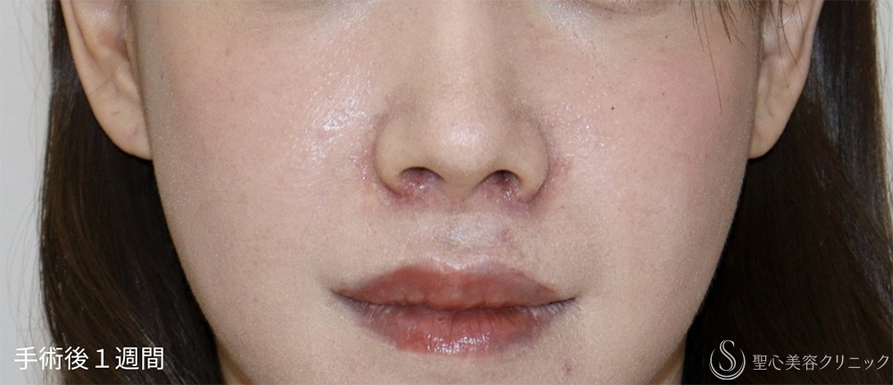 【30代女性・失われた構造を取り戻し、上品な“自然鼻”へ】鼻下短縮術（人中短縮）（1週間後） After 
