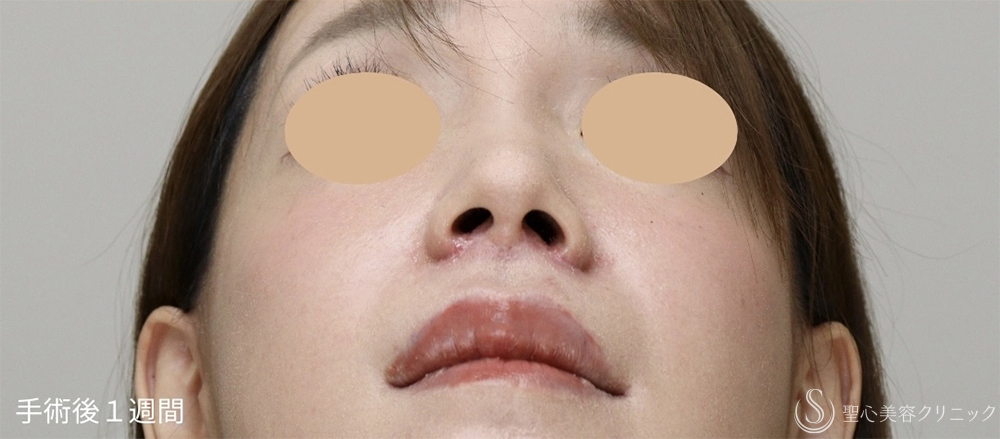 【30代女性・失われた構造を取り戻し、上品な“自然鼻”へ】鼻下短縮術（人中短縮）（1週間後） After 