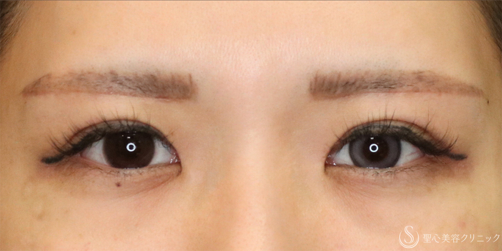 【20代女性・二重で目をパッチリ】二重全切開術＋目上切開＋眉下切開（1ヶ月後） After 名古屋・ハム目・まぶたのタルミ取り・二重・ぱっちり二重