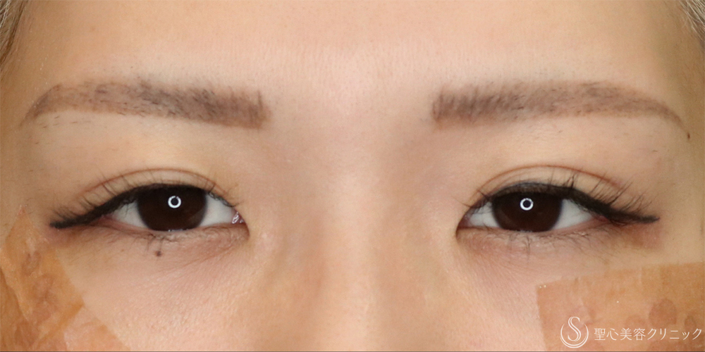 【20代女性・二重で目をパッチリ】二重全切開術＋目上切開＋眉下切開（1ヶ月後） Before 名古屋・ハム目・まぶたのタルミ取り・二重・ぱっちり二重