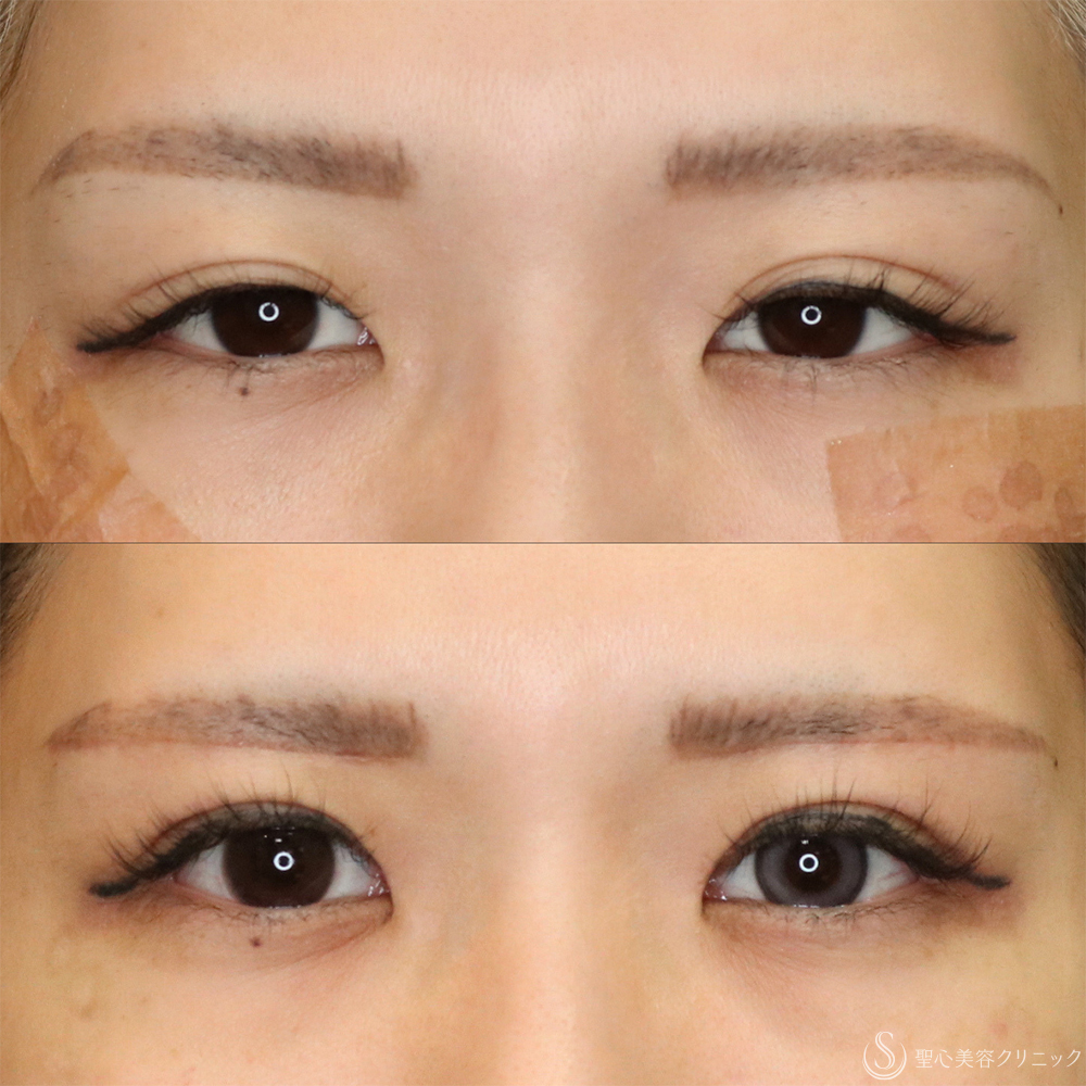 【20代女性・二重で目をパッチリ】二重全切開術＋目上切開＋眉下切開（1ヶ月後） After 名古屋・ハム目・まぶたのタルミ取り・二重・ぱっちり二重
