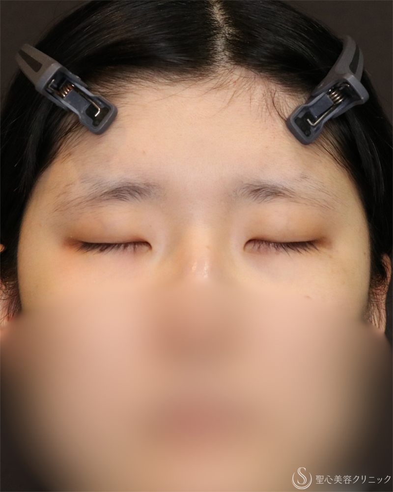 【20代女性・自然なデカ目】目頭切開/目上切開＋眉下切開法（眉下リフト）（4ヶ月後） Before 