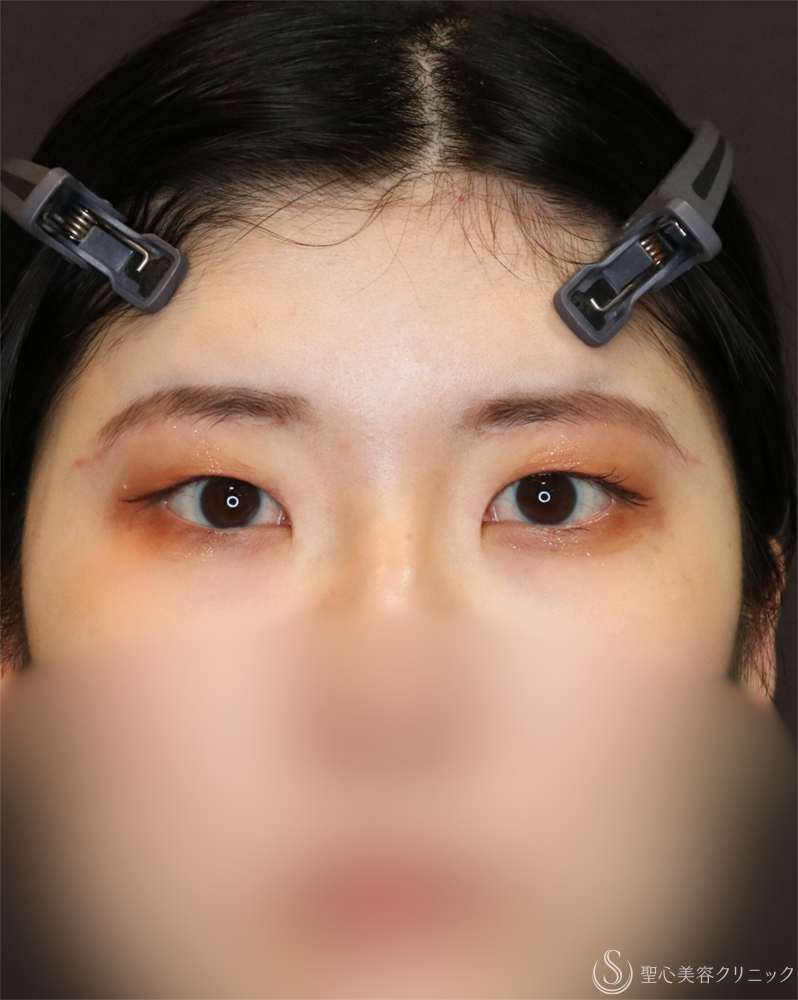 【20代女性・自然なデカ目】目頭切開/目上切開＋眉下切開法（眉下リフト）（4ヶ月後） After 