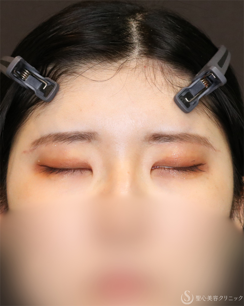 【20代女性・自然なデカ目】目頭切開/目上切開＋眉下切開法（眉下リフト）（4ヶ月後） After 
