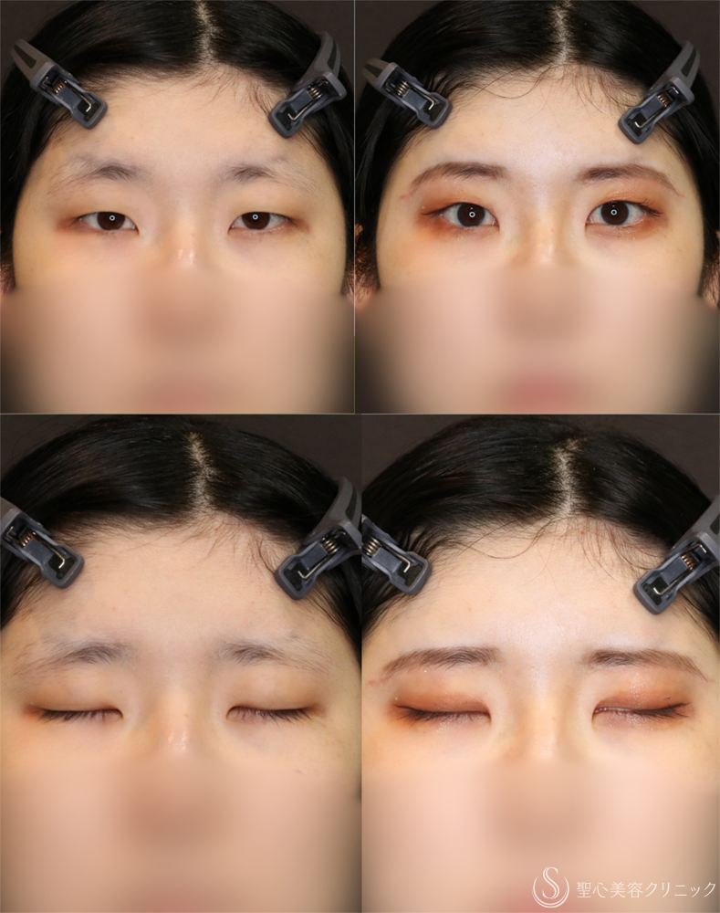 【20代女性・自然なデカ目】目頭切開/目上切開＋眉下切開法（眉下リフト）（4ヶ月後） After 