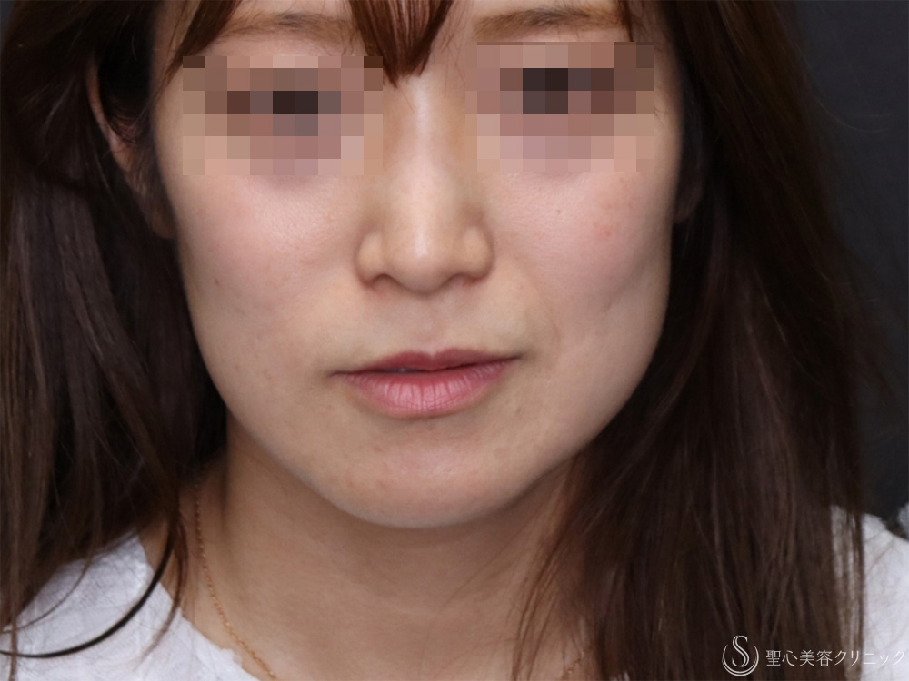 【40代女性・頬のたるみを引き締め小顔に】モノスレッド（ハーフサイドテスト）（3ヶ月後） Before 