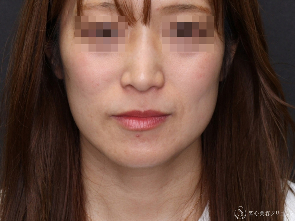 【40代女性・頬のたるみを引き締め小顔に】モノスレッド（ハーフサイドテスト）（3ヶ月後） After 