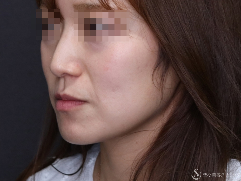 【40代女性・頬のたるみを引き締め小顔に】モノスレッド（ハーフサイドテスト）（3ヶ月後） Before 