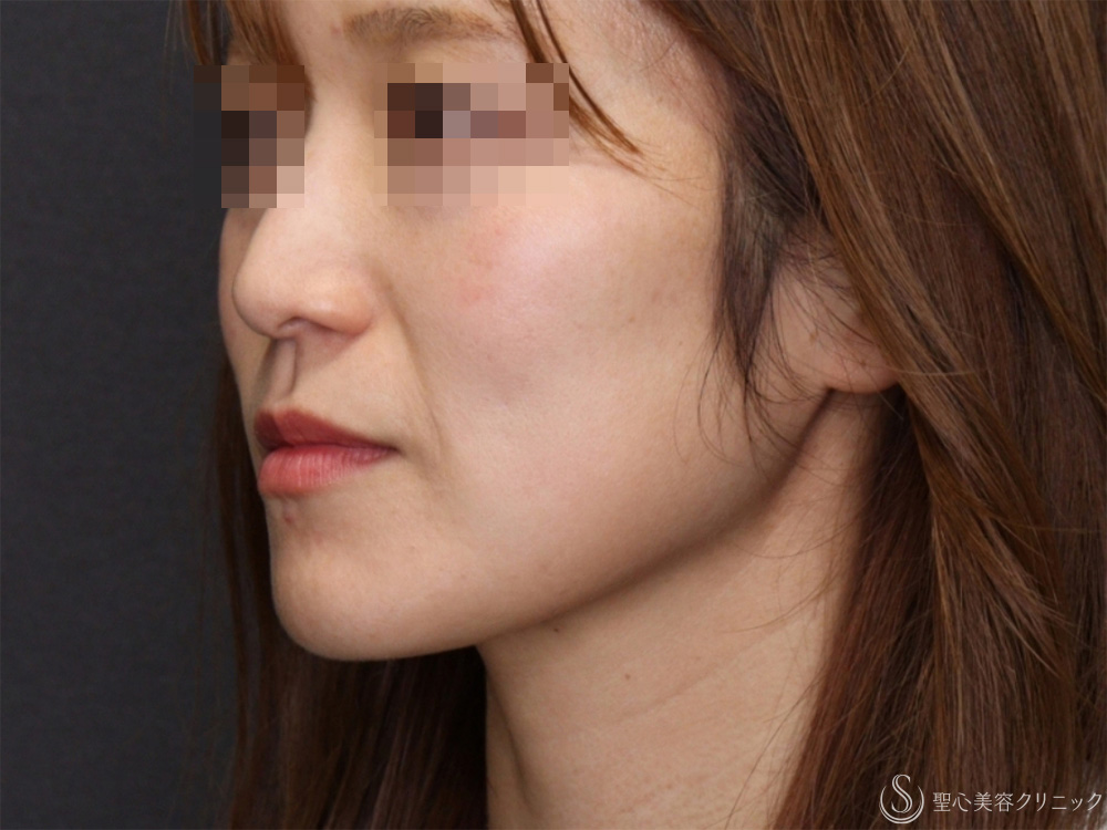 【40代女性・頬のたるみを引き締め小顔に】モノスレッド（ハーフサイドテスト）（3ヶ月後） After 
