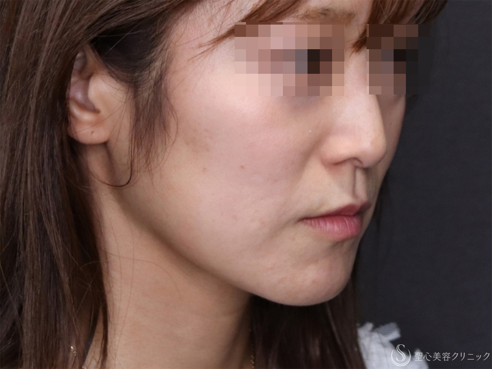 【40代女性・頬のたるみを引き締め小顔に】モノスレッド（ハーフサイドテスト）（3ヶ月後） Before 