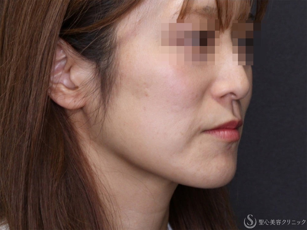 【40代女性・頬のたるみを引き締め小顔に】モノスレッド（ハーフサイドテスト）（3ヶ月後） After 