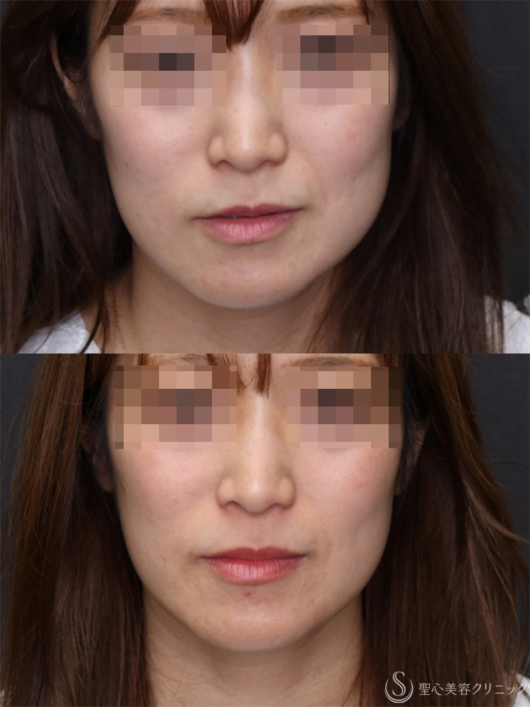 【40代女性・頬のたるみを引き締め小顔に】モノスレッド（ハーフサイドテスト）（3ヶ月後） After 