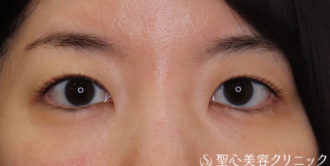 【30代女性・二重の幅を広くして若々しく】二重術（埋没法）：マイクロメソッド+α（1ヶ月後） Before 