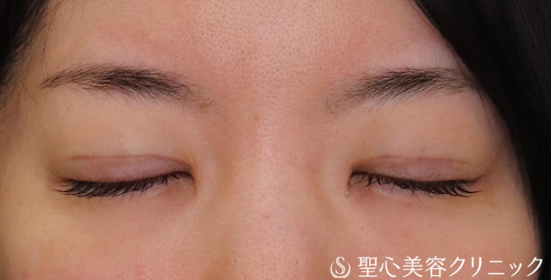 【30代女性・二重の幅を広くして若々しく】二重術（埋没法）：マイクロメソッド+α（1ヶ月後） After 