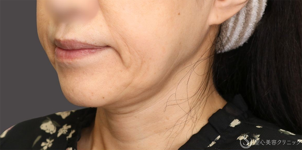 【50代女性・フェイスラインのもたつきがすっきり】 TESSリフト（テスリフト）（1ヶ月後） Before 名古屋+糸リフト　頬のたるみ　切らないフェイスリフト