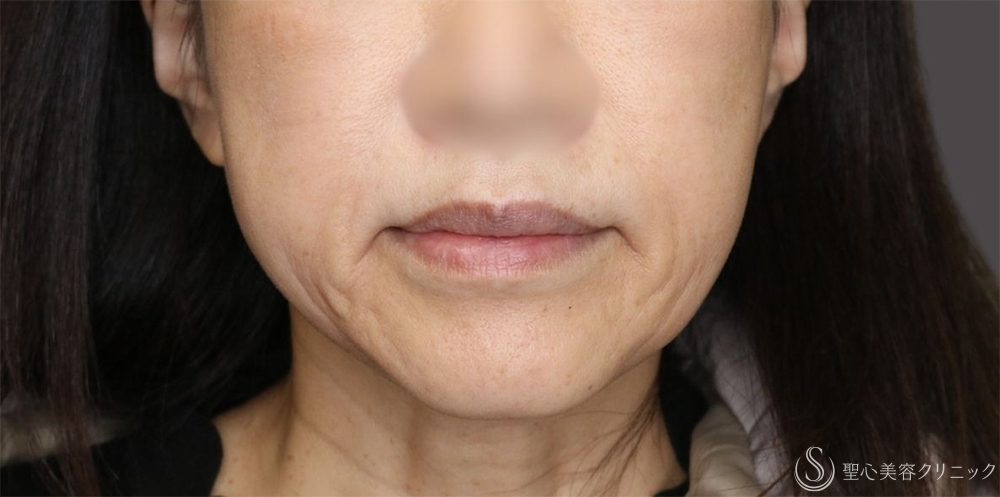 【50代女性・フェイスラインのもたつきがすっきり】 TESSリフト（テスリフト）（1ヶ月後） After 名古屋+糸リフト　頬のたるみ　切らないフェイスリフト