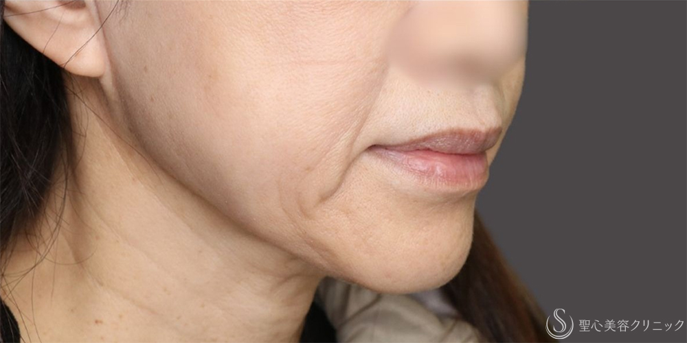 【50代女性・フェイスラインのもたつきがすっきり】 TESSリフト（テスリフト）（1ヶ月後） After 名古屋+糸リフト　頬のたるみ　切らないフェイスリフト