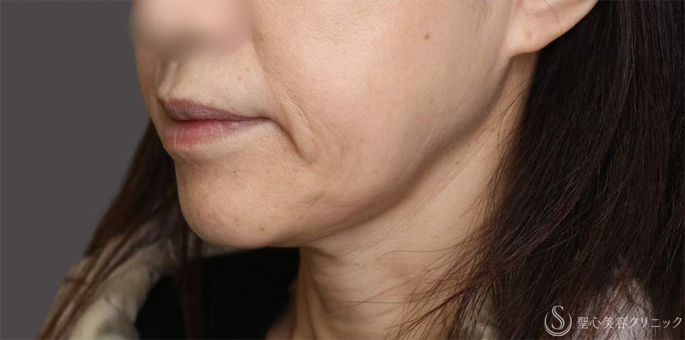 【50代女性・フェイスラインのもたつきがすっきり】 TESSリフト（テスリフト）（1ヶ月後） After 名古屋+糸リフト　頬のたるみ　切らないフェイスリフト