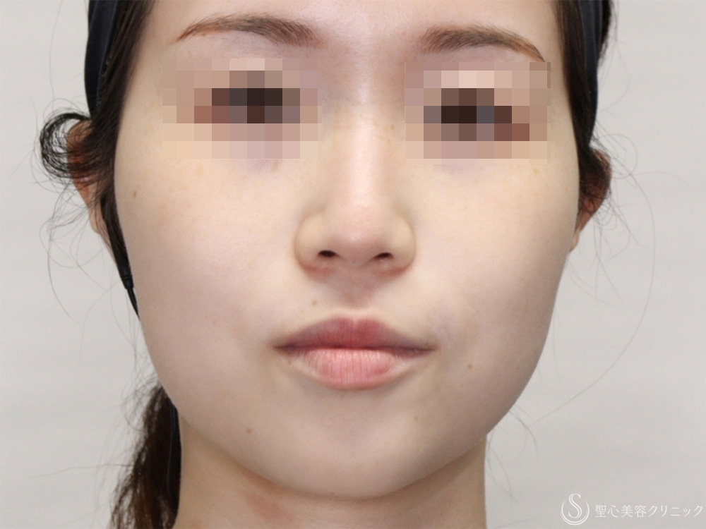 肌育スレッド（PDRN モノ）_Before