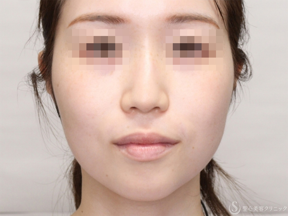 肌育スレッド（PDRN モノ）_After