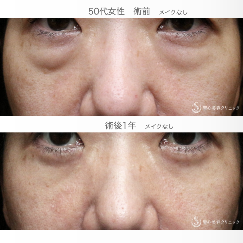 【50代女性・私が裏ハムラをしない理由】表ハムラ+α法「Ver.3」単独例（術直後〜1年後） Before 