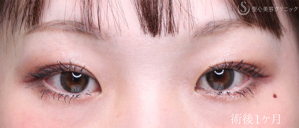 【20代女性・埋没法で目元の印象を激変】二重術（埋没法）：マイクロメソッド+α（術後1ヶ月）　 After 