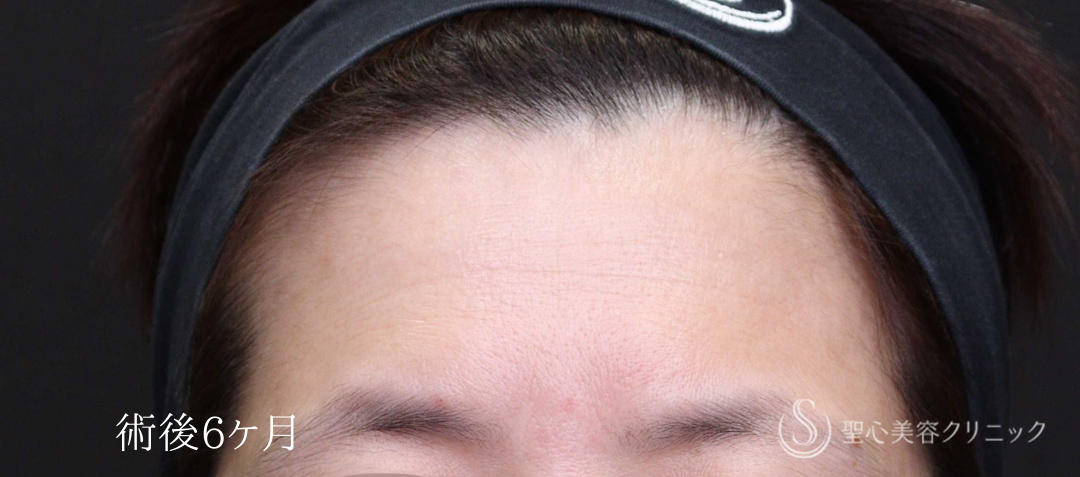 【40代女性・額のはり、凹みをPRPで改善】プレミアムPRP皮膚再生療法（術後6ヶ月） After 