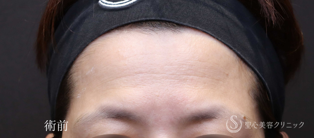 【40代女性・額のはり、凹みをPRPで改善】プレミアムPRP皮膚再生療法（術後6ヶ月） Before 
