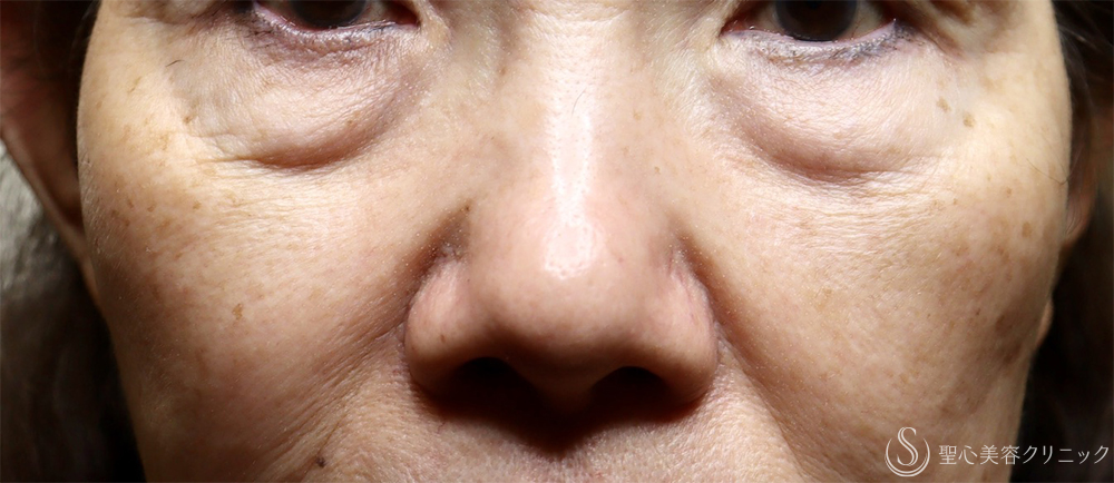 【70代女性・目の下のクマ】下眼瞼切開術/下眼瞼除皺術/ハムラ法（7日後） Before 