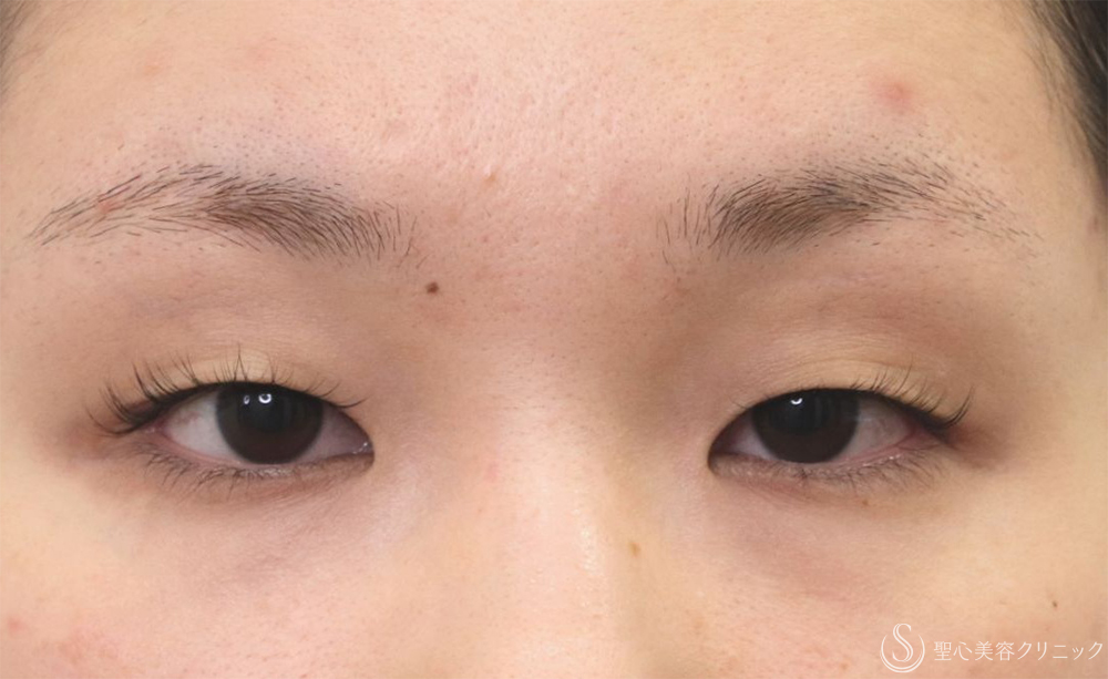 【20代女性・重く感じる一重を解消】マイクロメソッド+α 3点（直後） Before 