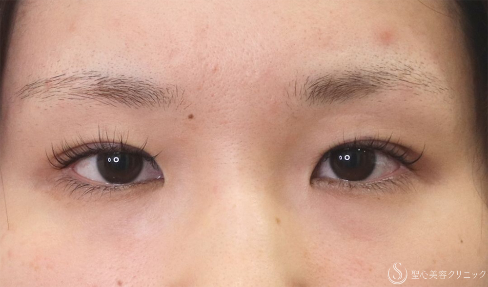 【20代女性・重く感じる一重を解消】マイクロメソッド+α 3点（直後） After 