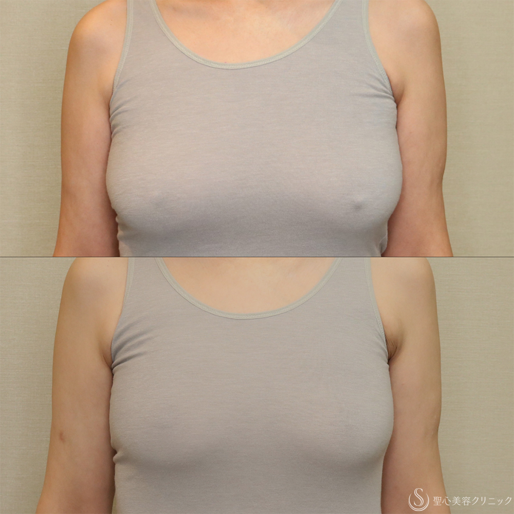 【60代女性・胸を小さくすっきりとした印象に】ベイザーリポ2.2脂肪吸引（胸）（1ヶ月後） After 名古屋+脂肪吸引　バストの悩み　乳房縮小