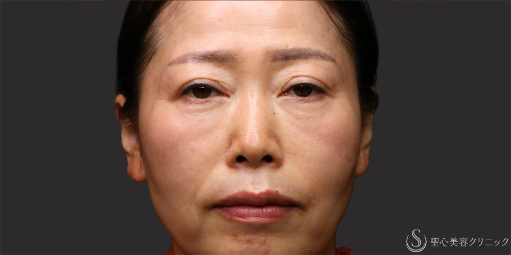 【50代女性・自然な若返り】 プレミアムPRP皮膚再生療法（頬・目の下・法令線）（1年11ヶ月後） After 名古屋・クマ治療・目の下のたるみ・頬こけ・アンチエイジング
