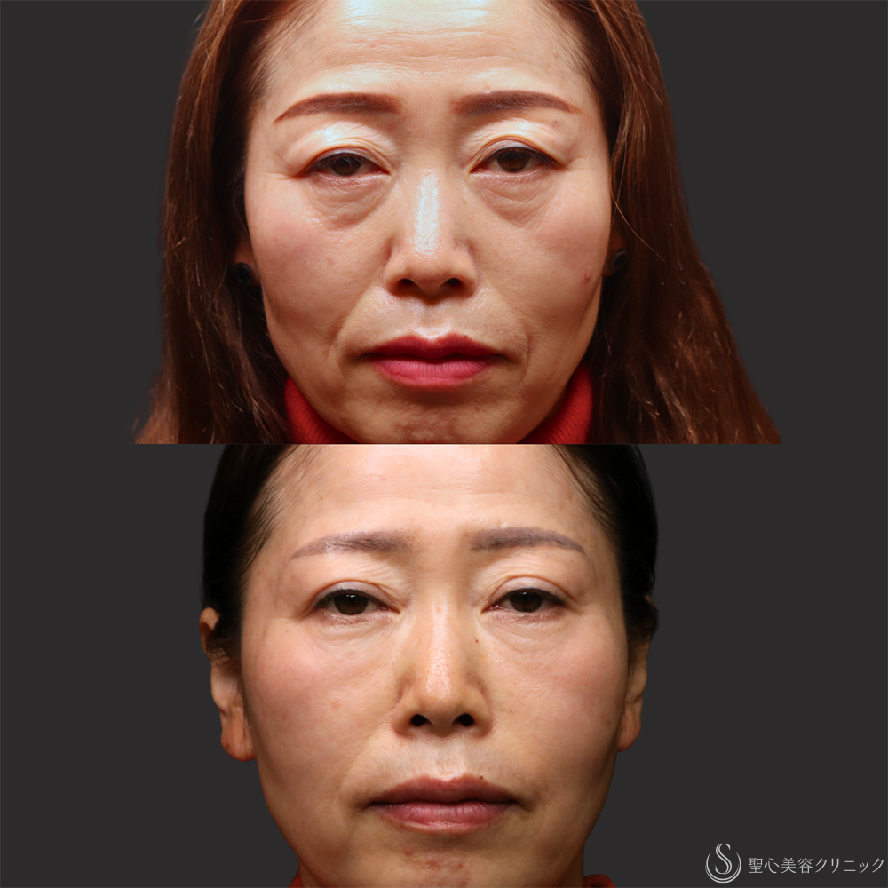 【50代女性・自然な若返り】 プレミアムPRP皮膚再生療法（頬・目の下・法令線）（1年11ヶ月後） After 名古屋・クマ治療・目の下のたるみ・頬こけ・アンチエイジング