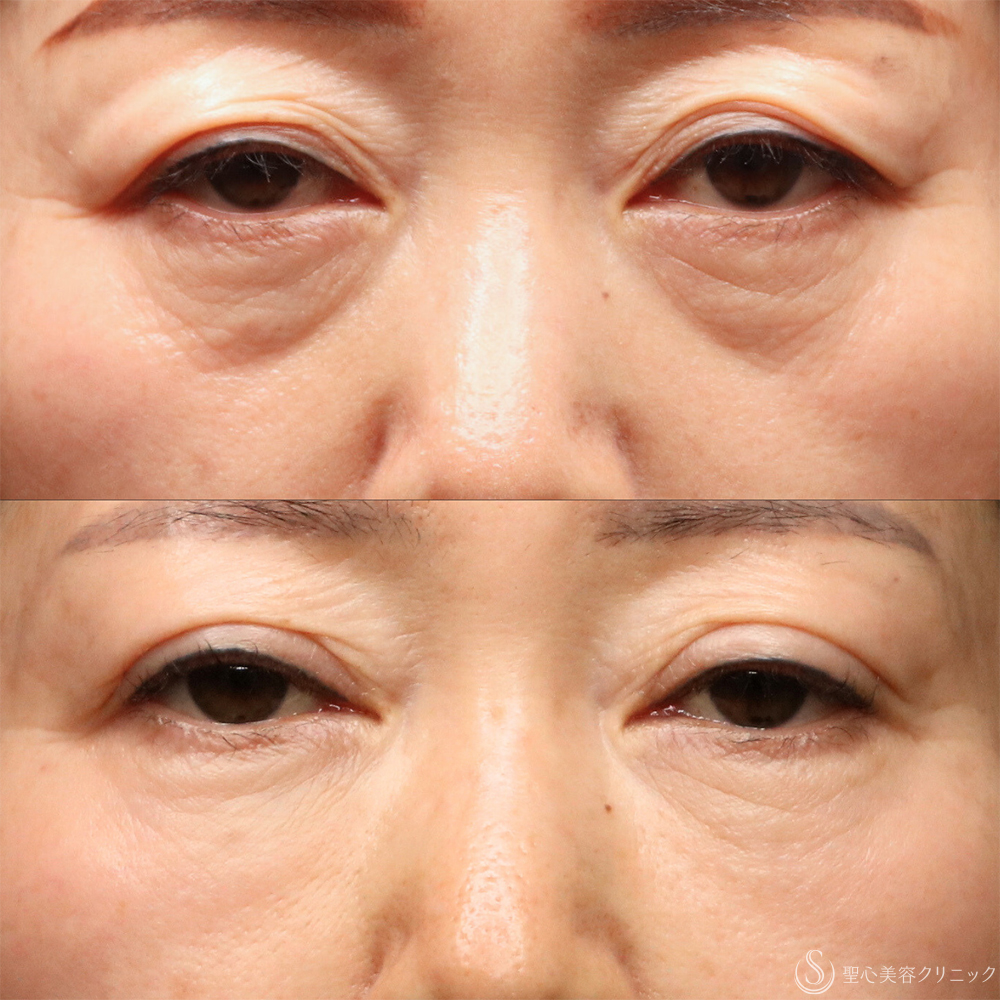 【50代女性・自然な若返り】 プレミアムPRP皮膚再生療法（頬・目の下・法令線）（1年11ヶ月後） After 名古屋・クマ治療・目の下のたるみ・頬こけ・アンチエイジング