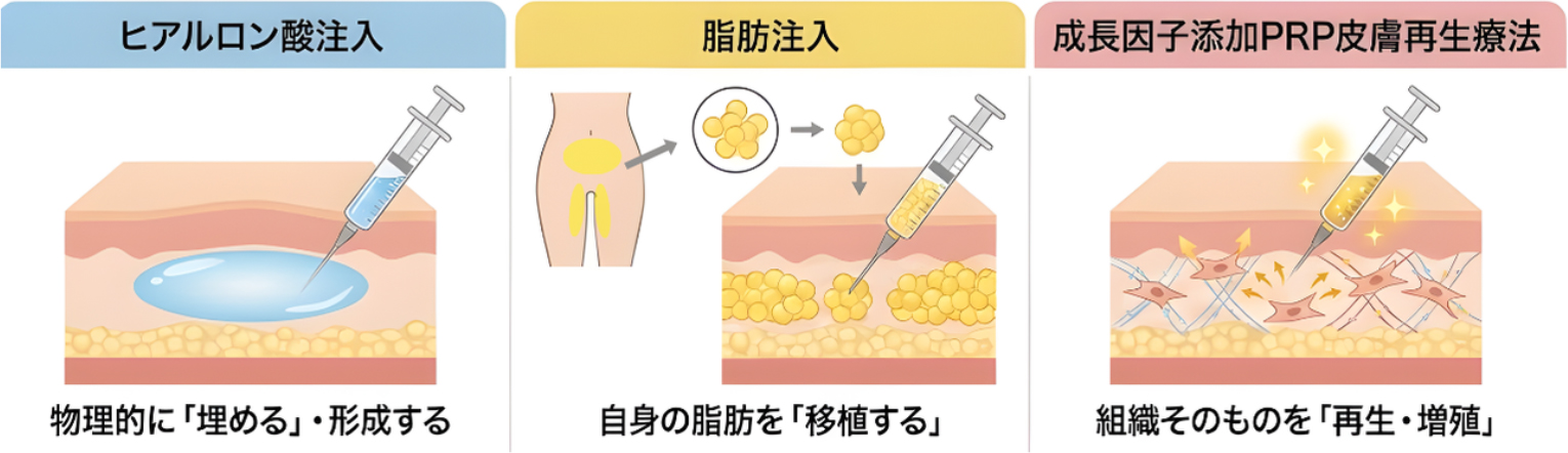 「埋めるヒアルロン酸」・「移植する脂肪注入」・「再生するPRP」各治療法のメカニズム