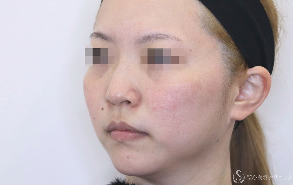 【30代女性・鼻筋がスッキリ】鼻尖縮小＋耳介軟骨＋Gメッシュ3本（10日後） Before 