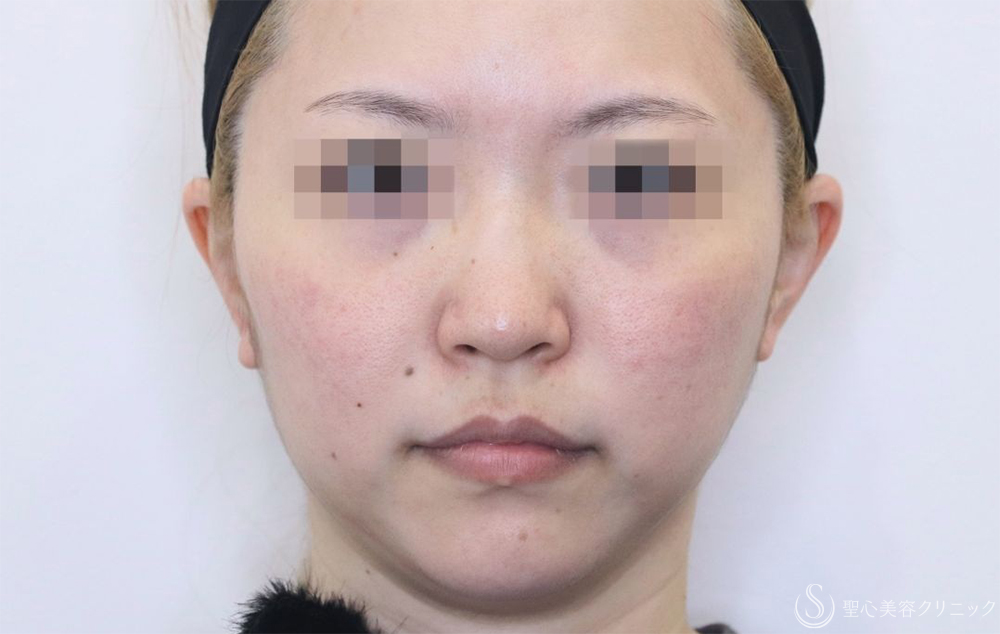 【30代女性・鼻筋がスッキリ】鼻尖縮小＋耳介軟骨＋Gメッシュ3本（10日後） Before 