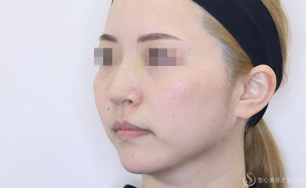【30代女性・鼻筋がスッキリ】鼻尖縮小＋耳介軟骨＋Gメッシュ3本（10日後） After 