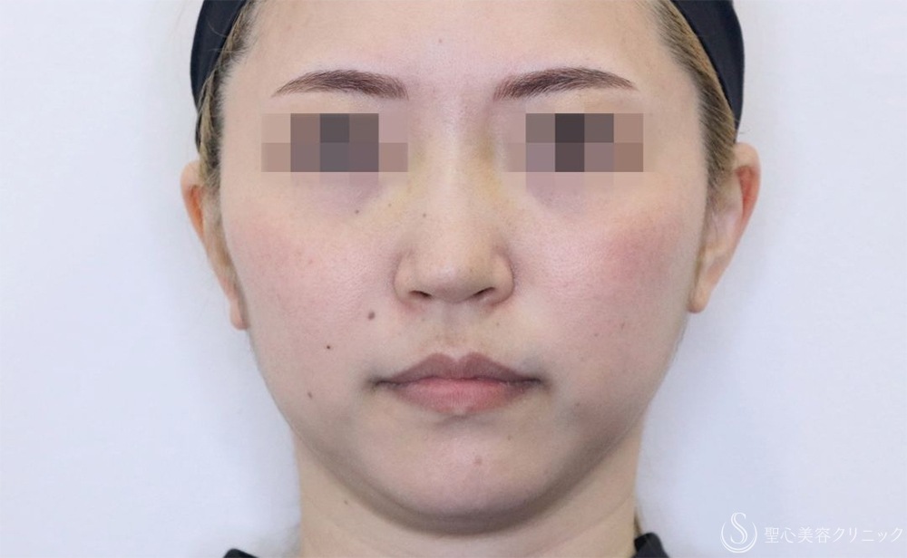【30代女性・鼻筋がスッキリ】鼻尖縮小＋耳介軟骨＋Gメッシュ3本（10日後） After 
