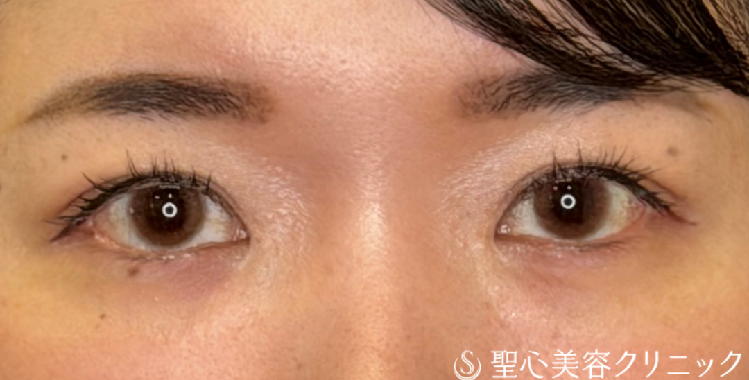 【30代女性・注入で目元を華やかに】ヒアルロン酸注入（涙袋）（直後） Before 