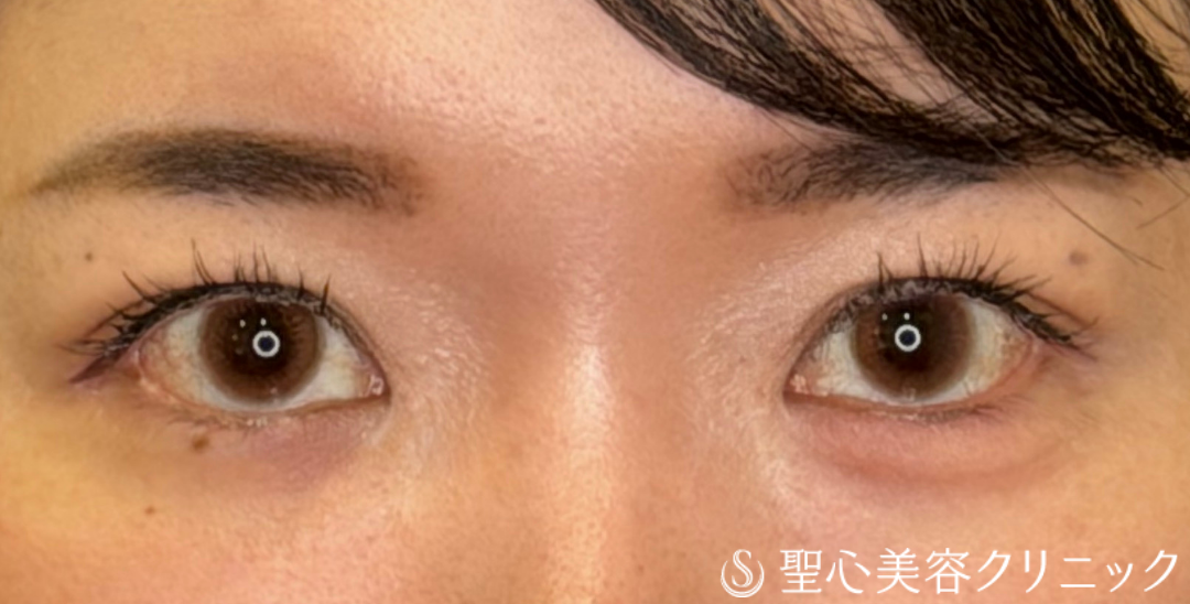 【30代女性・注入で目元を華やかに】ヒアルロン酸注入（涙袋）（直後） After 