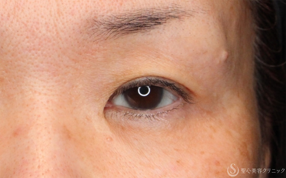【50代女性・左まぶたの開き改善】眼瞼下垂（埋没法）（左のみ）（1ヶ月後） Before 